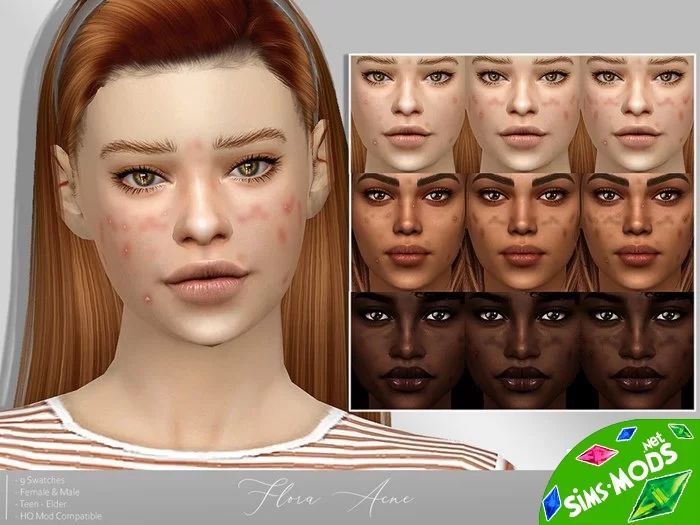 Прыщи Flora Acne от MSQSIMS